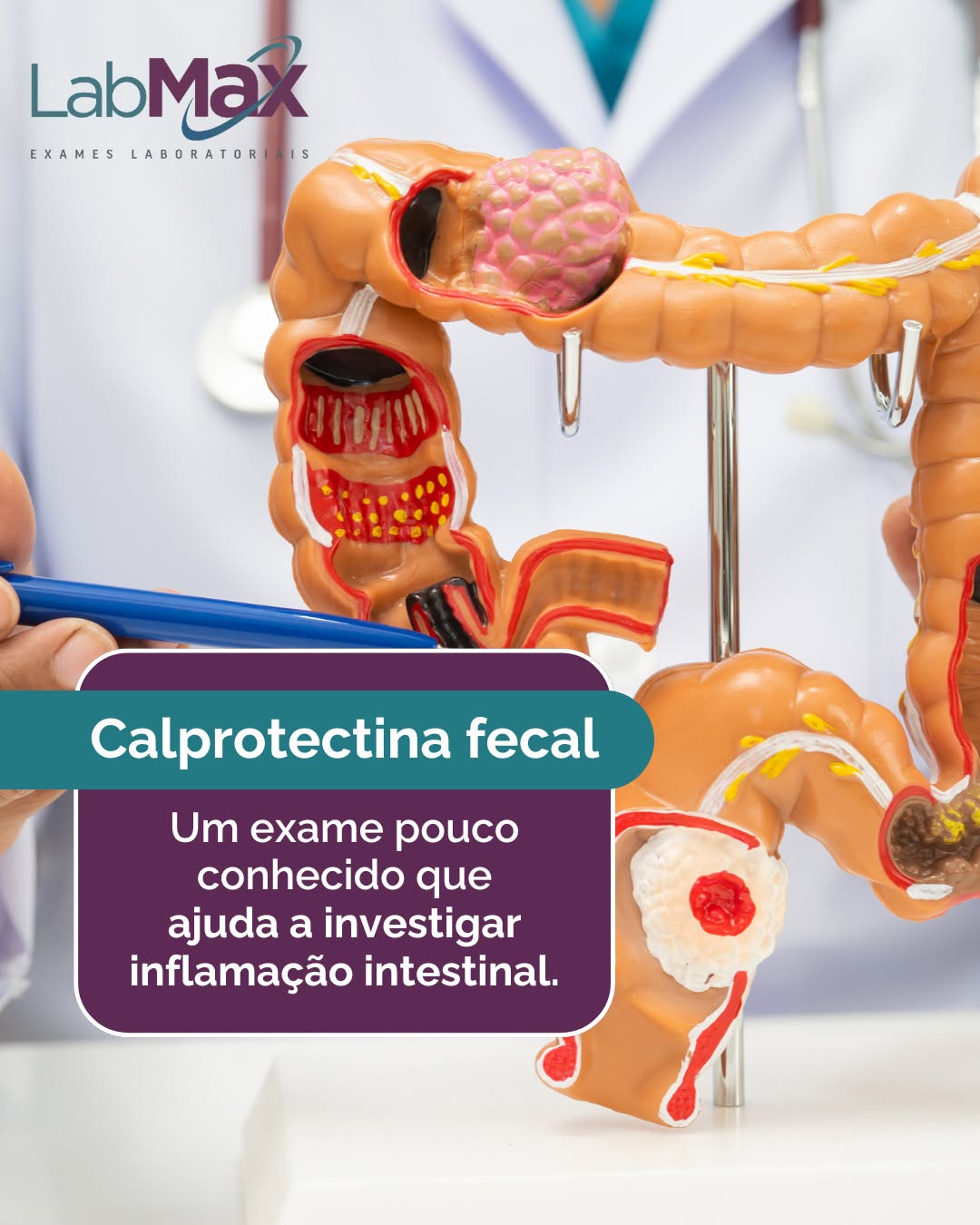 Alguns sintomas digestivos persistentes, como diarreia recorrente, dor abdominal ou alterações intestinais prolongadas, podem levar o médico a investigar possíveis processos inflamatórios no intestino.

Nesse contexto, um exame que pode ser solicitado é a calprotectina fecal, um marcador utilizado como apoio na avaliação de inflamações intestinais.

Ele ajuda o médico a diferenciar algumas causas de sintomas gastrointestinais e orientar melhor os próximos passos da investigação.

Se o seu médico solicitou esse exame, conte com o Labmax.

📍 Av. Ipiranga, 4343 - Zona I, Umuarama - PR.
📞 (44) 3055-3255

#Calprotectina #SaúdeIntestinal #ExamesLaboratoriais